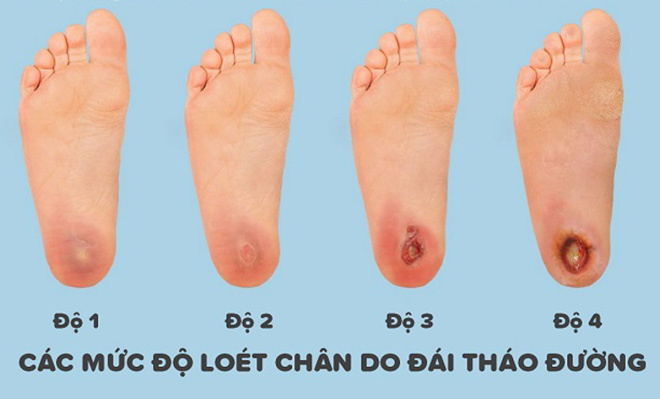 Các mức độ loét chân do đái tháo đường