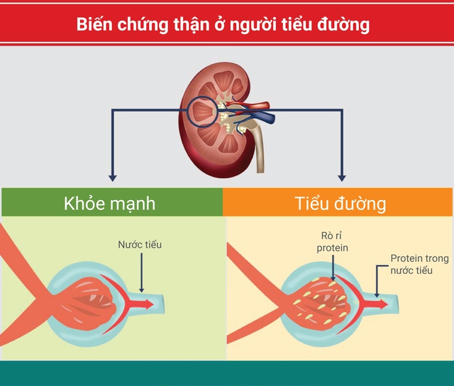 Biến chứng thận ở người tiểu đường