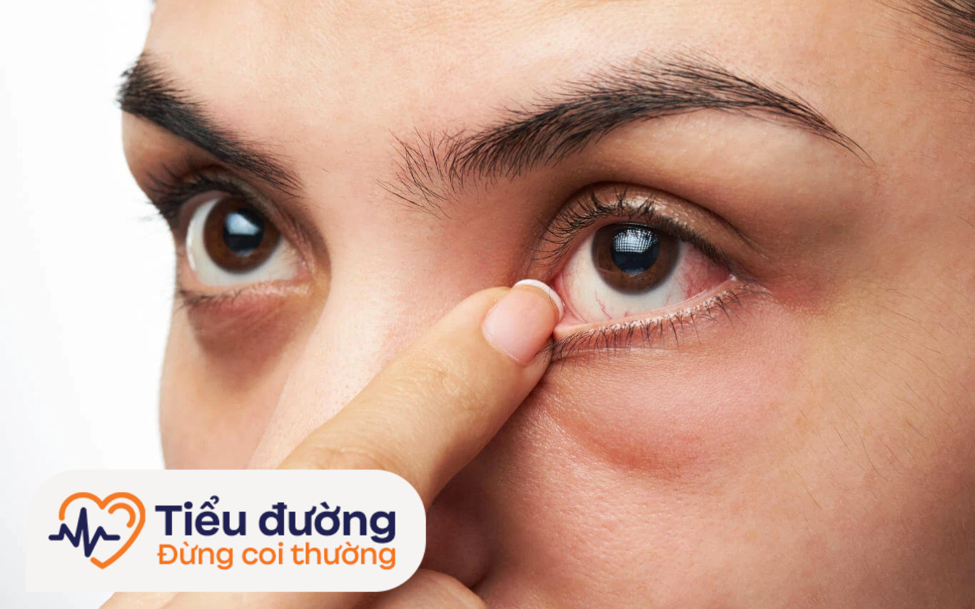 Võng mạc tiểu đường
