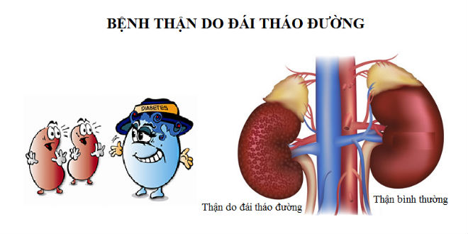 Bệnh Thận Tiểu Đường